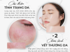 Liệu Pháp Oxy Tinh Khiết 90% – Bí Quyết Cải Thiện Tình Trạng Da & Chữa Lành Vết Thương Hiệu Quả