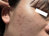 Điều Trị Mụn Viêm, Mụn Mủ