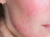 Điều Trị Da Nhiễm Corticoid