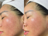 Phi kim tế bào gốc máu cuống rốn