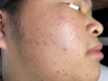 Điều trị mụn cơ bản 