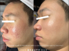 Trọn gói điều trị mụn chuyên sâu