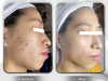 Điều trị mụn Nano men vi sinh 