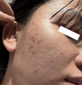 Điều Trị Mụn Viêm, Mụn Mủ