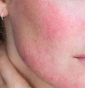 Điều Trị Da Nhiễm Corticoid