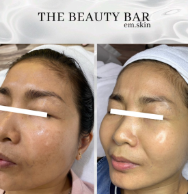 Điều Trị Nám, Tàn Nhang 