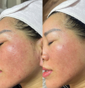 Phi kim tế bào gốc máu cuống rốn