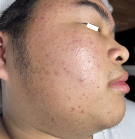 Điều trị mụn cơ bản 