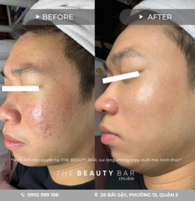 Trọn gói điều trị mụn chuyên sâu