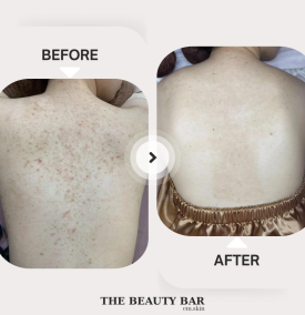 Điều trị mụn vùng lưng