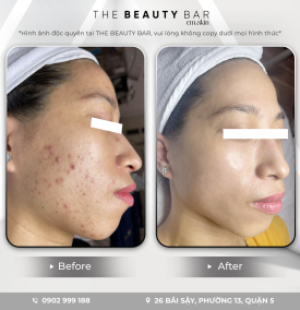 Điều trị mụn Nano men vi sinh 