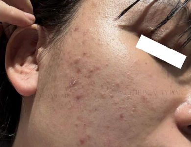 Điều Trị Mụn Viêm, Mụn Mủ