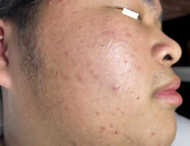 Điều trị mụn cơ bản 
